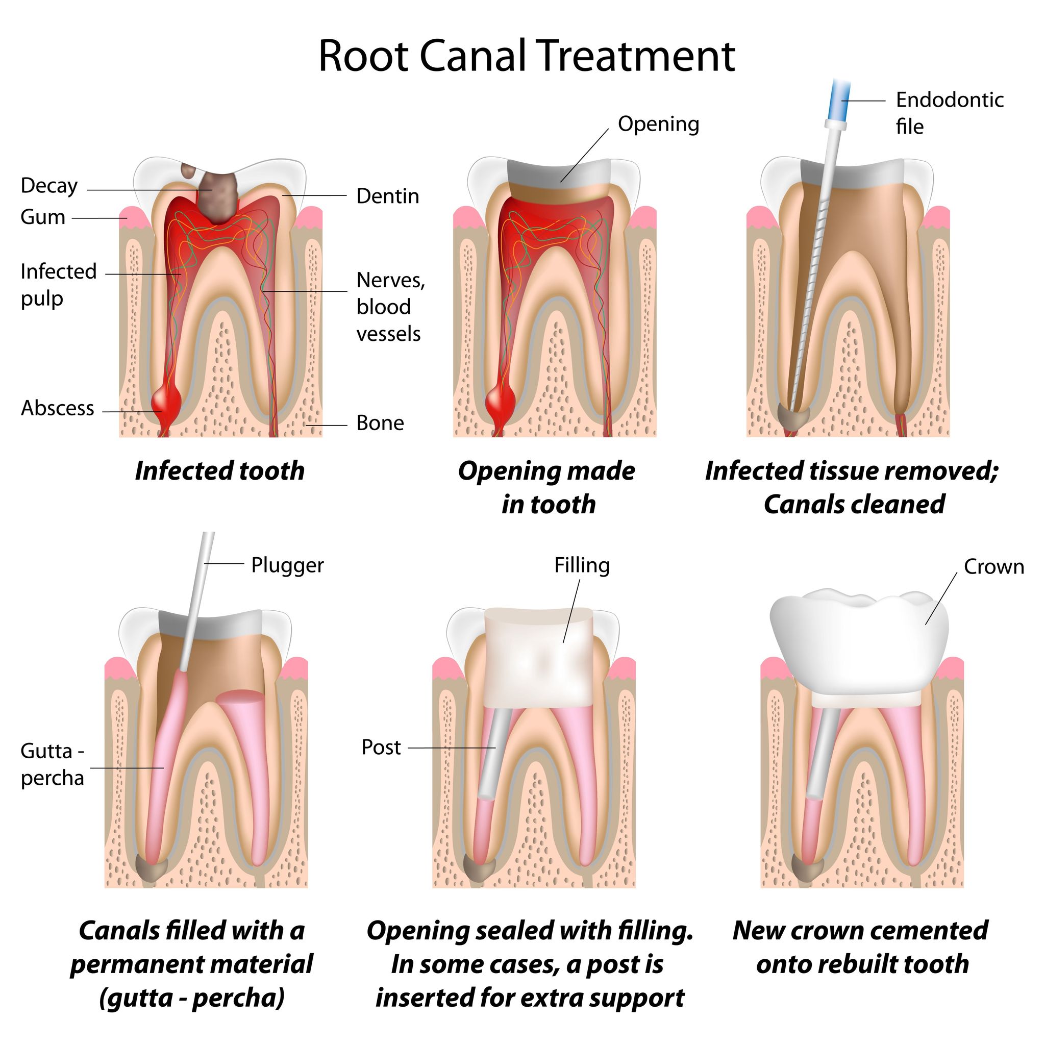 What To Expect During Root Canal Surgery