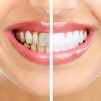 Seek Professional Help for Teeth Whitening in Kalamazoo, MI