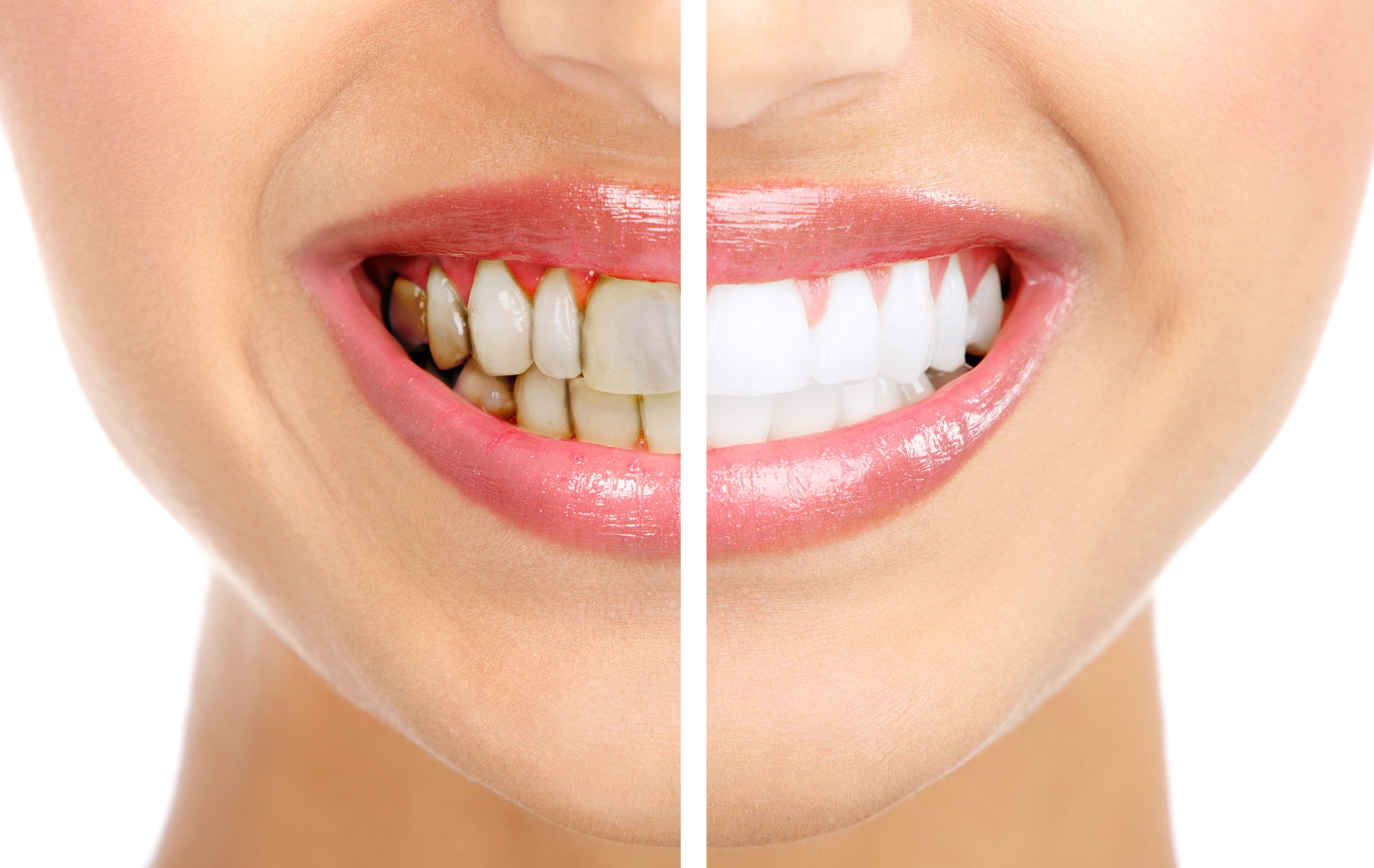 Seek Professional Help for Teeth Whitening in Kalamazoo, MI