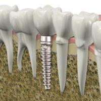 Dental Implants in Santa Maria, CA Can Improve Your Smile
