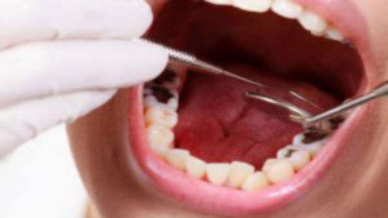 Basic Guidelines To Avoid Cavities And Tooth Loss