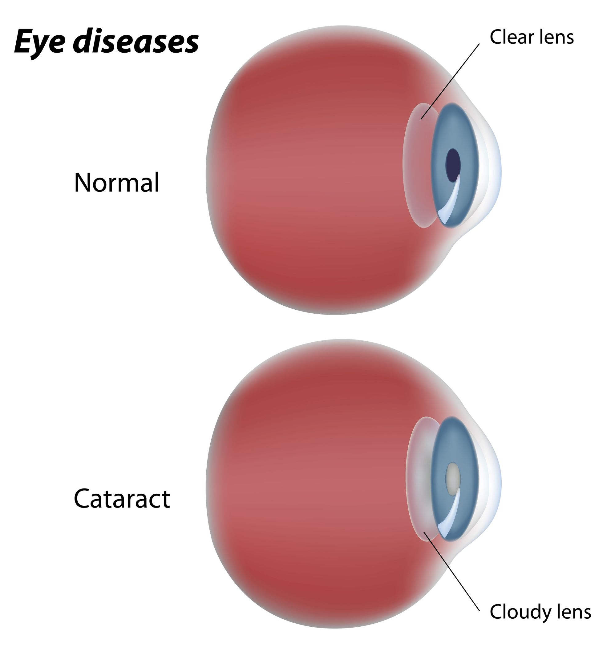 Facts About Cataracts and Cataract Surgery in Honolulu