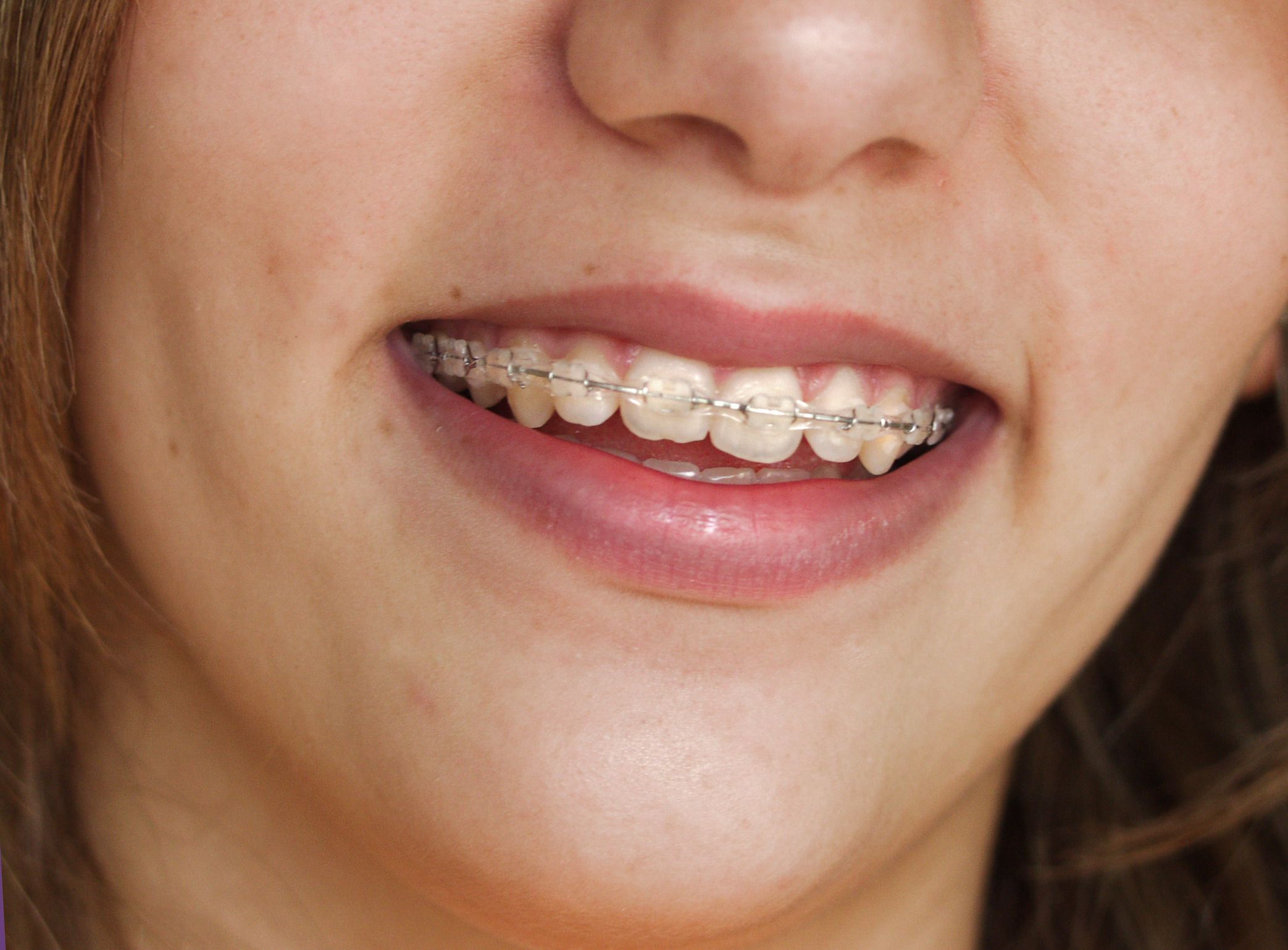 Dental Patients in San Jose: Invisalign Can Straigten Your Teeth