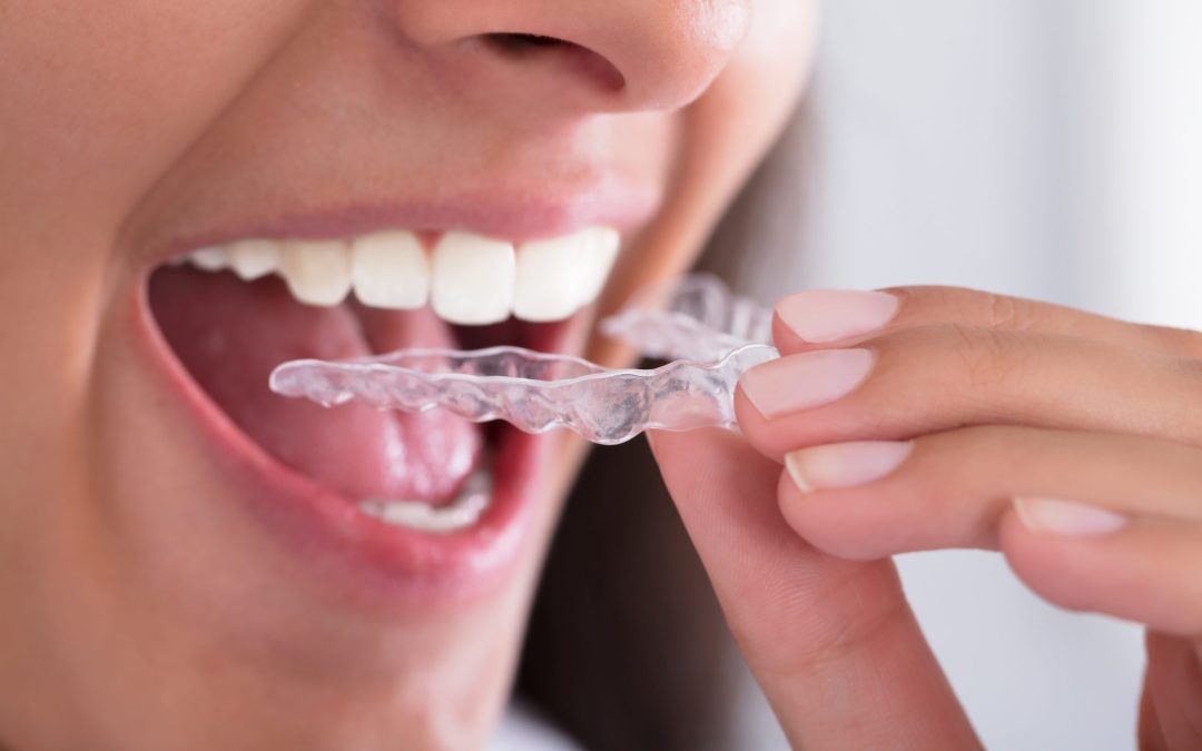 Benefits You Gain From Getting Braces In Medina OH For Straight Teeth